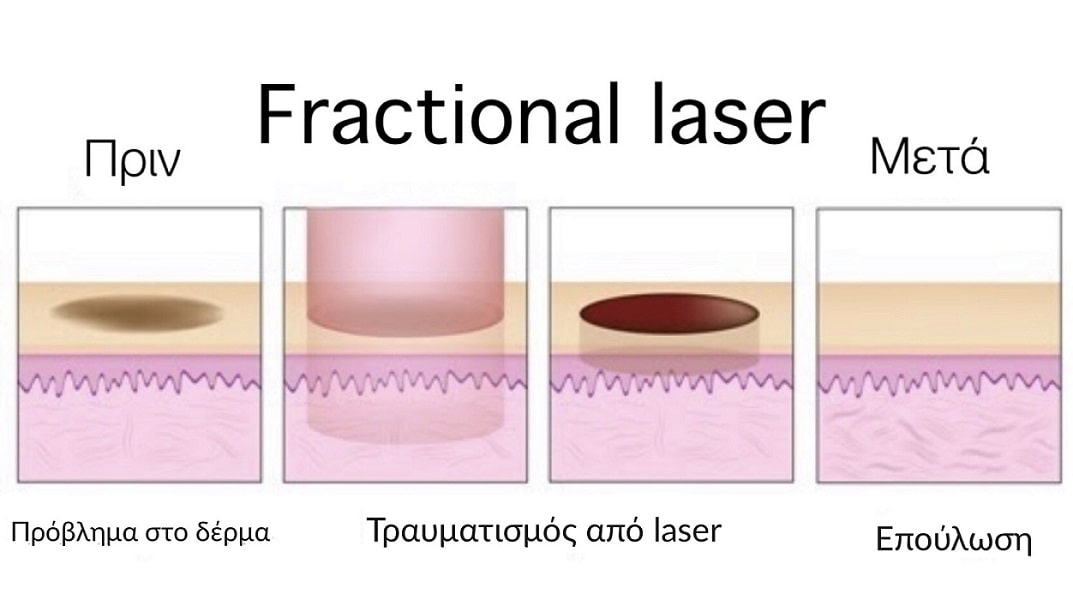 fractional laser διαδικασία vector