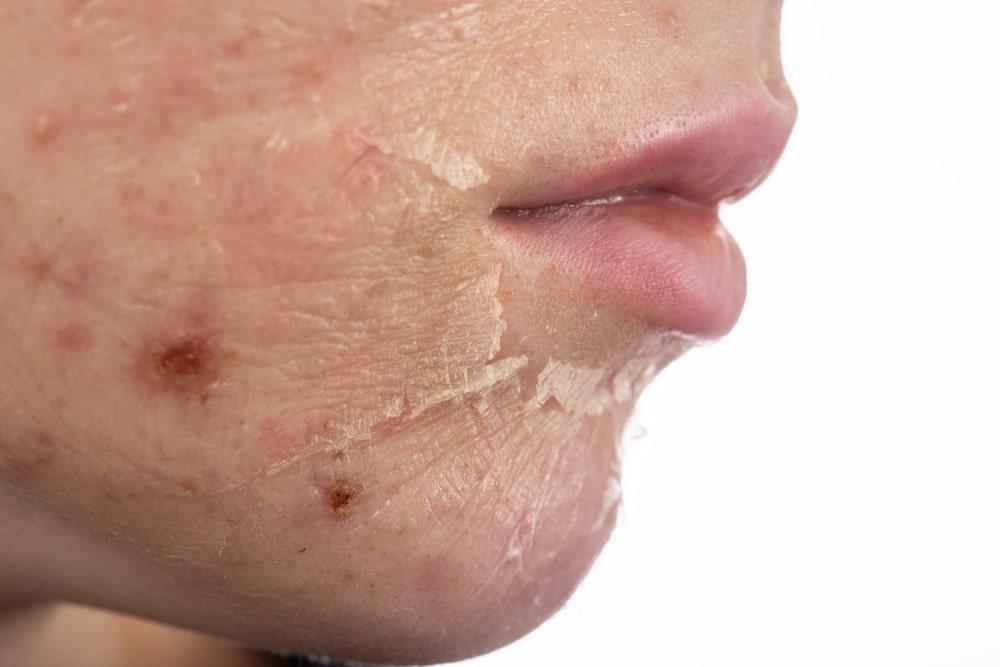 χημικό peeling στο πρόσωπο μετά την διαδικασία εφαρμογής ξεφλούδισμα