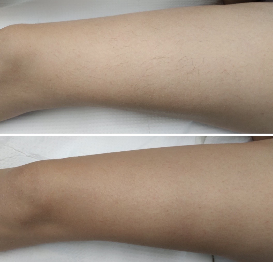 αποτρίχωση με laser Αλεξανδρίτη πριν και μετά πόδια