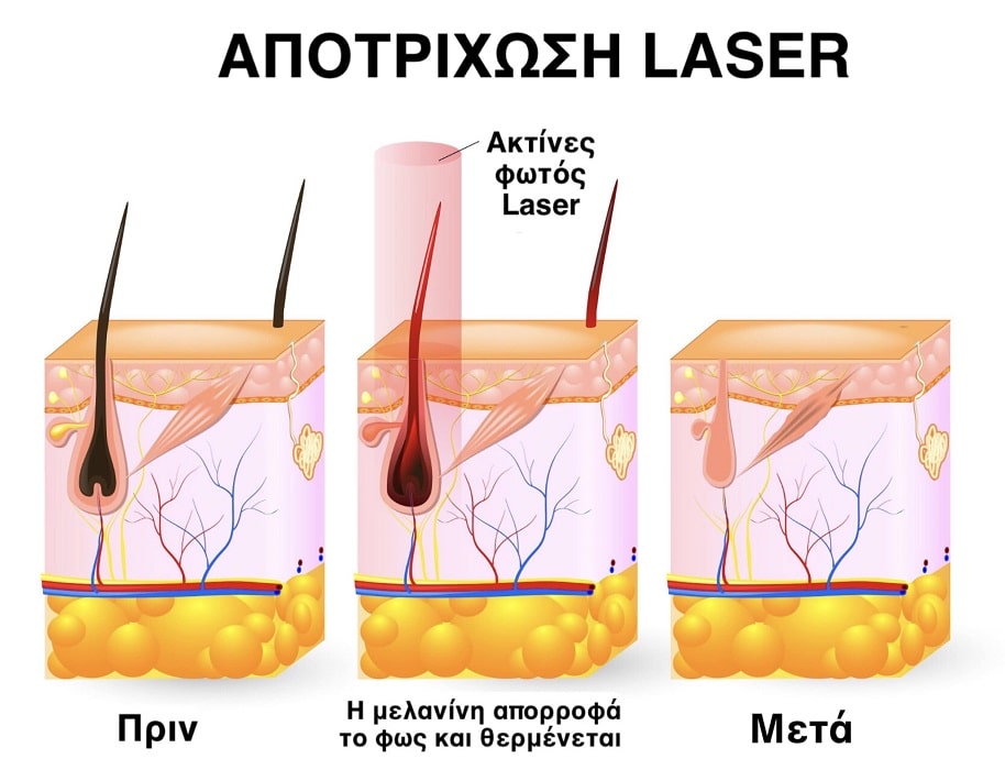 Πως λειτουργει η αποτριχωση Laser Alexandriti