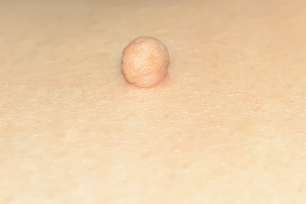 θήλωμα μικρός όγκος στο δέρμα που δεν είναι καρκίνος