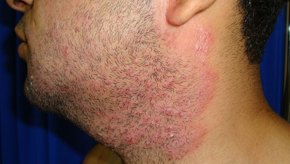 φωτογραφία θυλακίτιδα στο λαιμό άντρα από το ξύρισμα 