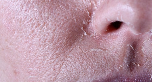 χημικό peeling στο πρόσωπο μετά την εφαρμογή