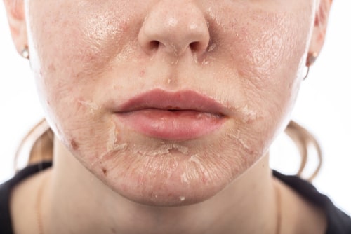 χημικό peeling στο πρόσωπο μετά ξεφλούδισμα